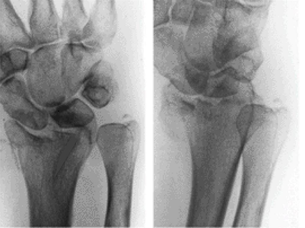 Distal Radius Fractures Trauma Orthobullets